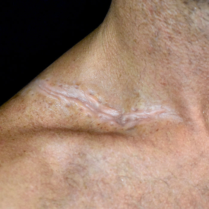 Mangled Scar